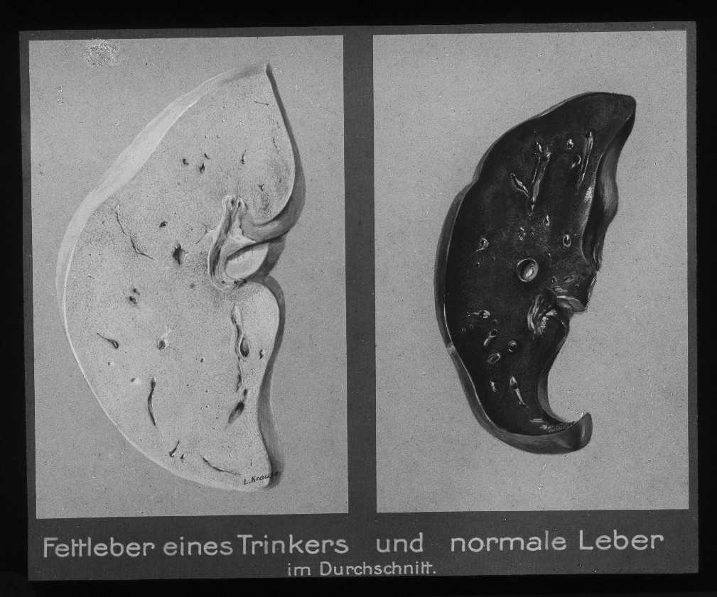 Fettleber eines Trinkers und normale Leber im Durchschnitt