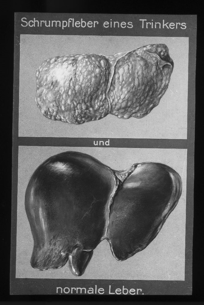 Schrumpfleber eines Trinkers und normale Leber