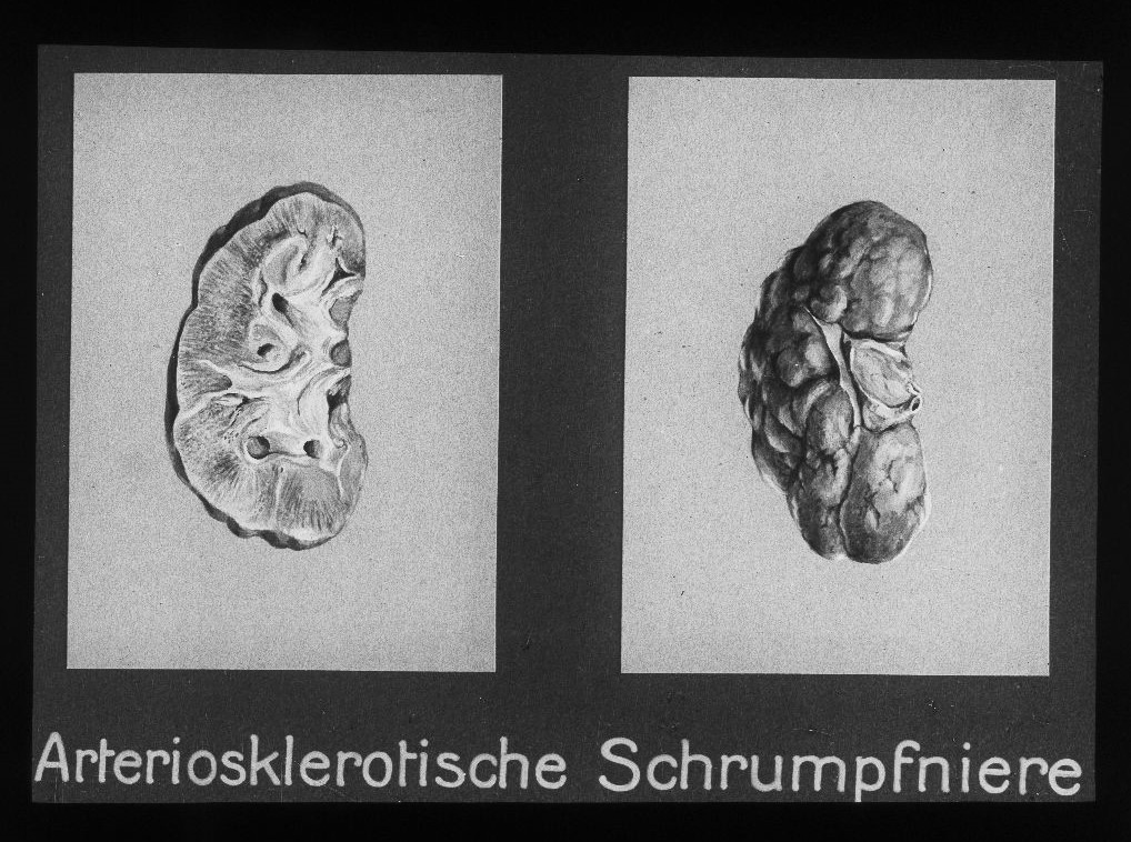 Schrumpfniere eines Trinkers.  