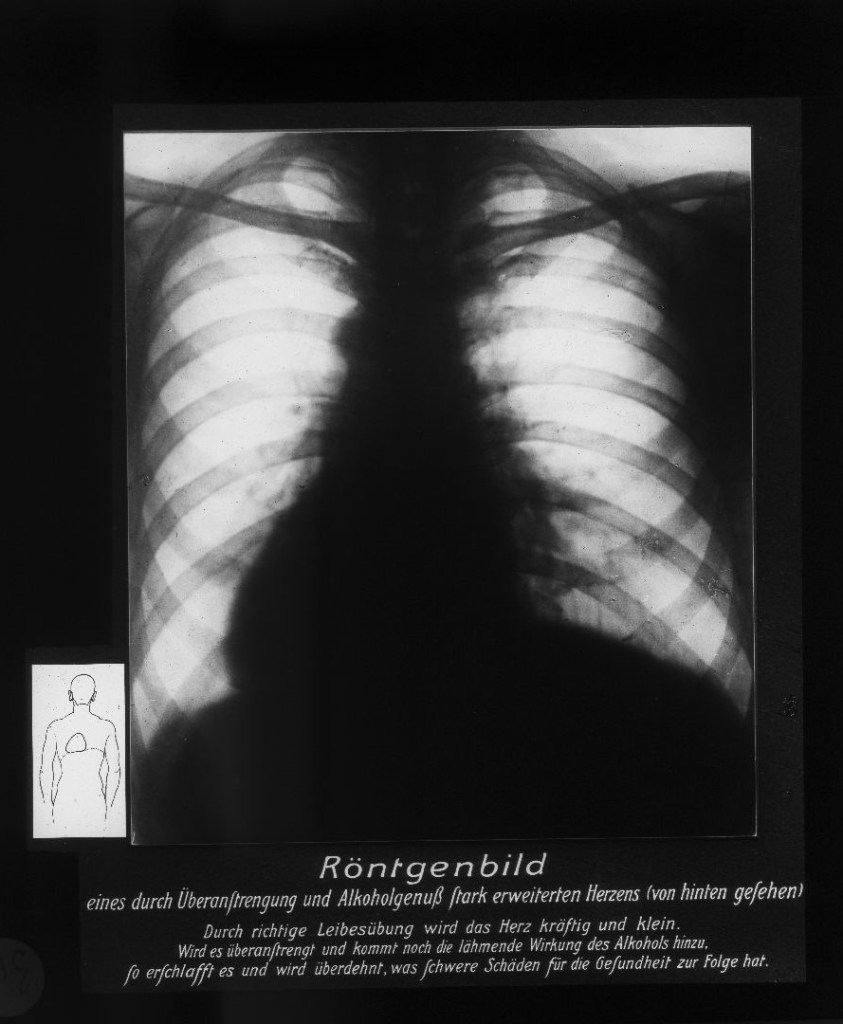 Herzerweiterung infolge Überanstrengung und Alkoholgenuß (Röntgenbild)