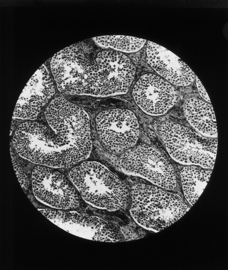 Querschnitt durch den Hoden bei einem 20jährigen Trinker. (Nach einem mikr. Originalpräparat von Professor Weichselbaum.) Keimgewebe entartet, zwischen den geschrumpften Hodenkanälchen massenhaft Bindegewebe.